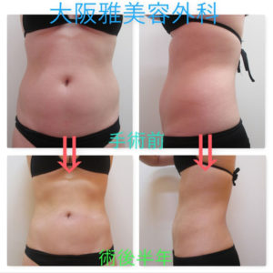 お腹と腰の脂肪吸引【Tさん】｜脂肪吸引ブログ【大阪雅