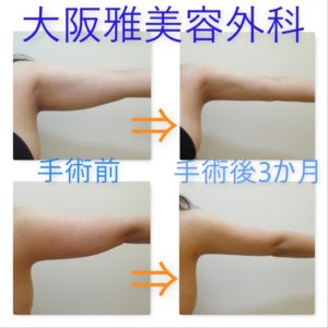 上腕